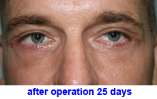 plastic-surgery-blepharoplasty